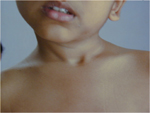 Torticollis