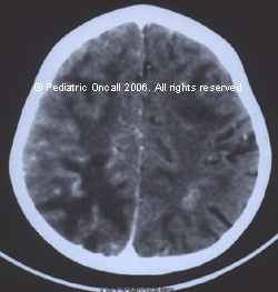 Cns Toxoplasmosis | Spot Diagnosis | Pediatric Oncall