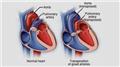 Transposition of Great Arteries