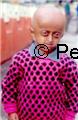 Progeria