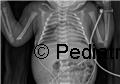 Neonatal pneumomediastinum: a pathognomonic radiological sign