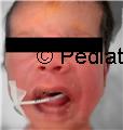 A neonate with Erythematous rash over face