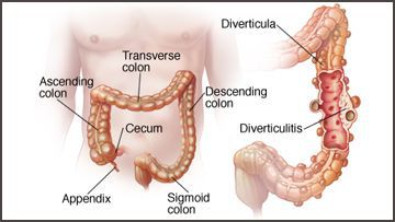 Ectopic Anus