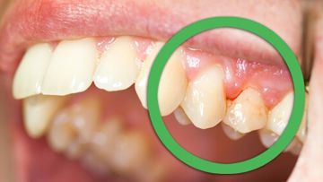 Gingivitis (Bleeding Gums)