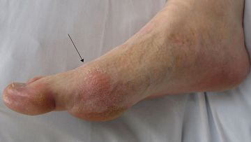 Gout - Blood Picture