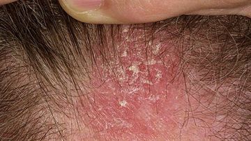 Psoriasis