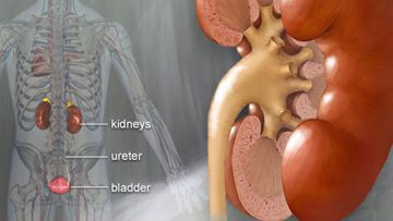 Renal (Kidney) Stones