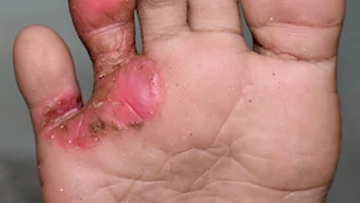 Staphylococcal Scaled Skin Syndrome