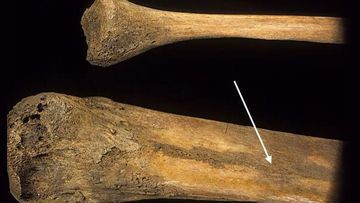 Tuberculosis of The Spine