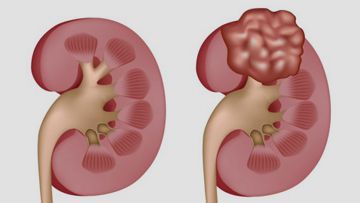 Wilm's Tumor (Nephroblastoma)